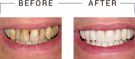 The image shows a person s teeth before and after cosmetic dental treatment, highlighting the transformation achieved through a smile makeover.